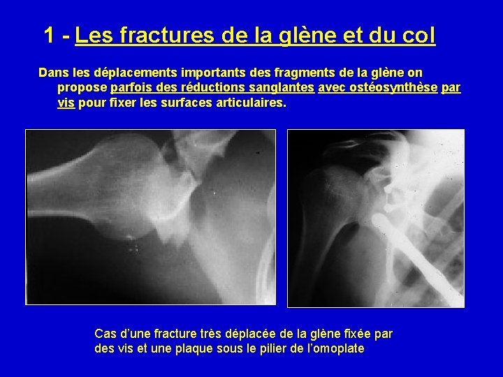 1 - Les fractures de la glène et du col Dans les déplacements importants