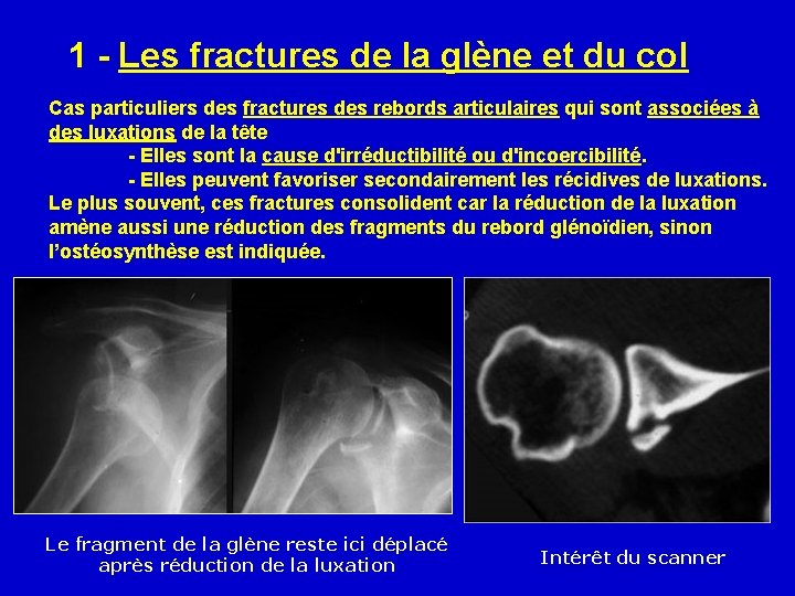 1 - Les fractures de la glène et du col Cas particuliers des fractures