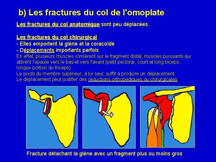 b) Les fractures du col de l'omoplate Les fractures du col anatomique sont peu