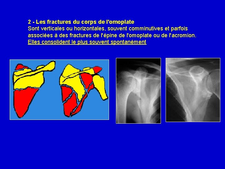 2 - Les fractures du corps de l'omoplate Sont verticales ou horizontales, souvent comminutives