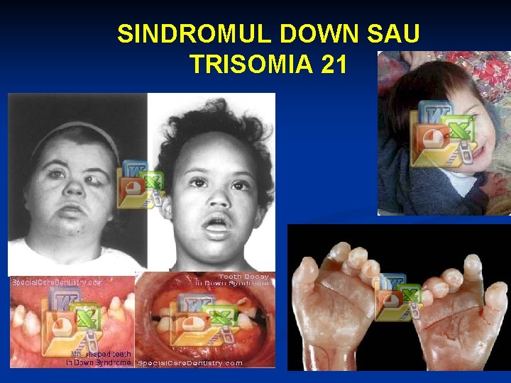 SINDROMUL DOWN SAU TRISOMIA 21 