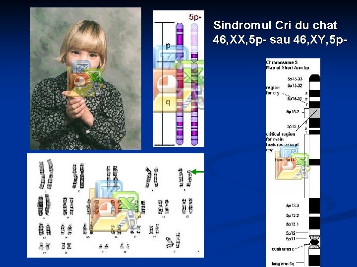 Sindromul Cri du chat 46, XX, 5 p- sau 46, XY, 5 p- 