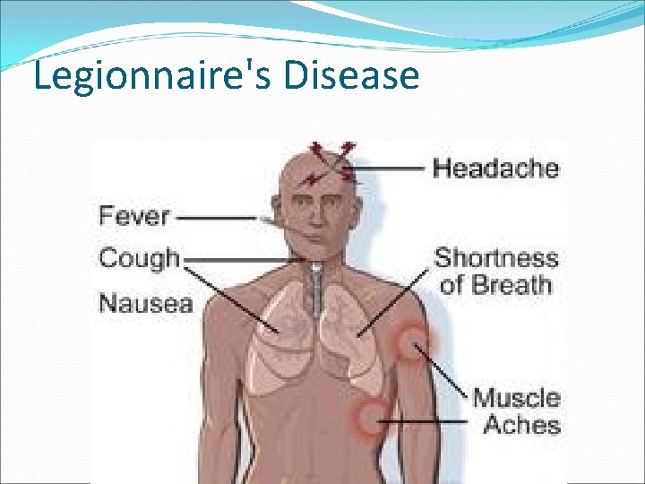 Legionnaire's Disease 