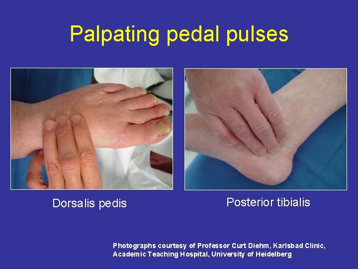 Palpating pedal pulses Dorsalis pedis Posterior tibialis Photographs courtesy of Professor Curt Diehm, Karlsbad