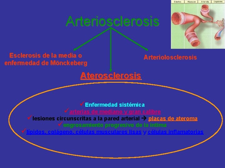 Arteriosclerosis Esclerosis de la media o enfermedad de Mönckeberg Arteriolosclerosis Aterosclerosis üEnfermedad sistémica üarterias