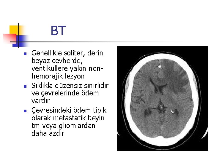 BT n n n Genellikle soliter, derin beyaz cevherde, ventiküllere yakın nonhemorajik lezyon Sıklıkla