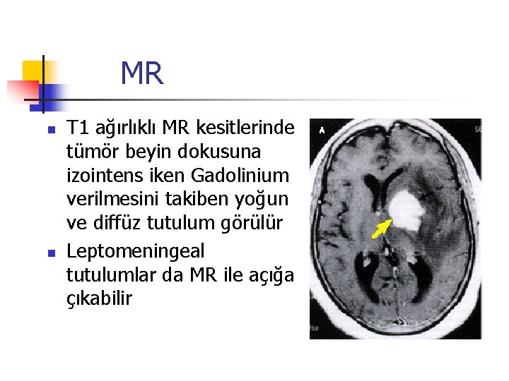 MR n n T 1 ağırlıklı MR kesitlerinde tümör beyin dokusuna izointens iken Gadolinium