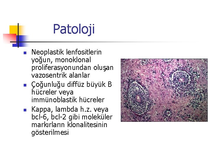 Patoloji n n n Neoplastik lenfositlerin yoğun, monoklonal proliferasyonundan oluşan vazosentrik alanlar Çoğunluğu diffüz