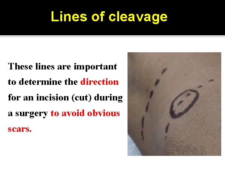 Lines of cleavage These lines are important to determine the direction for an incision