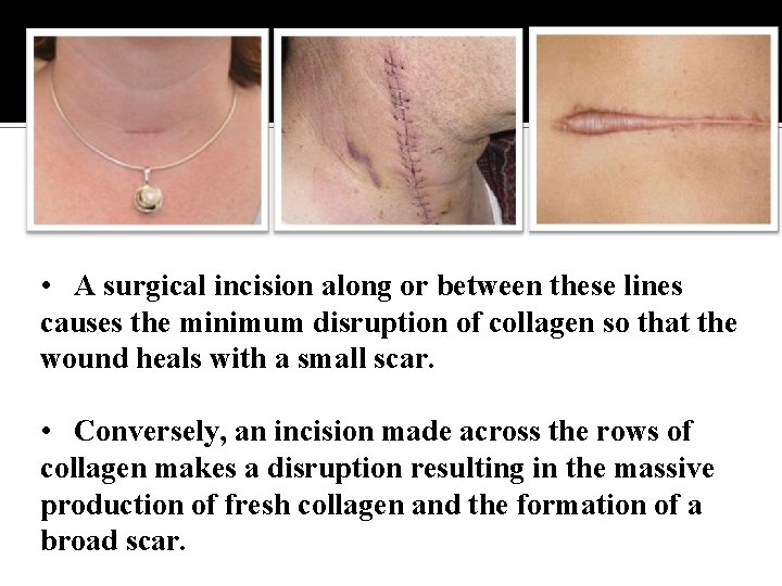  • A surgical incision along or between these lines causes the minimum disruption