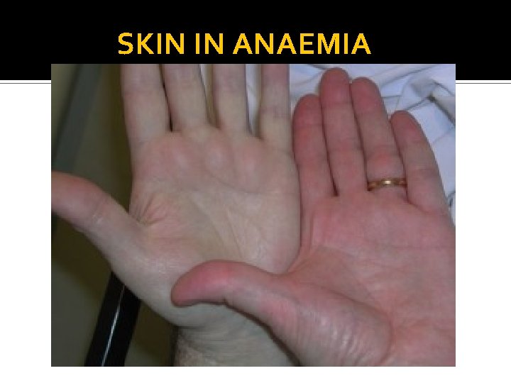 SKIN IN ANAEMIA 