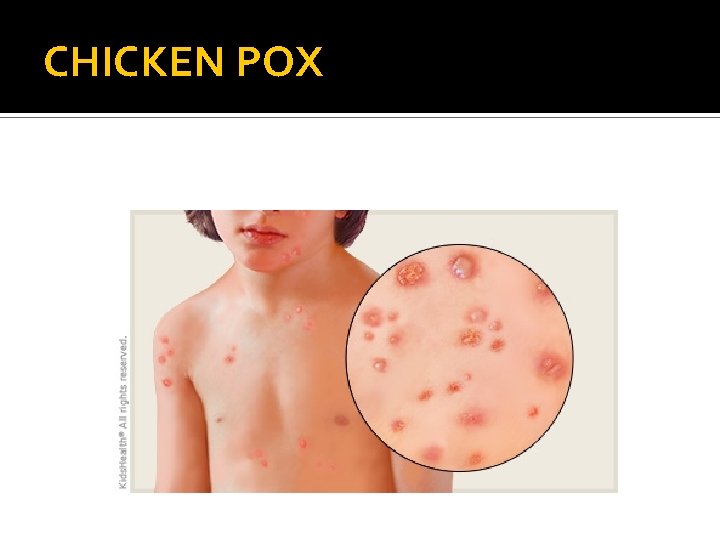 CHICKEN POX 