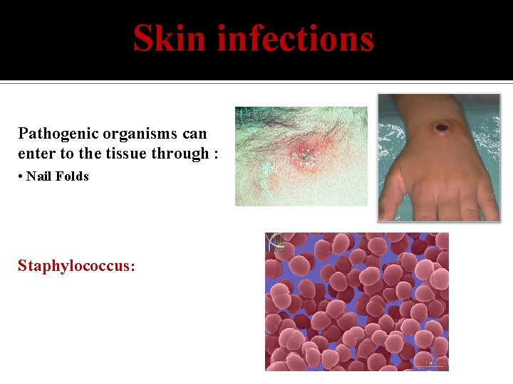 Skin infections Pathogenic organisms can enter to the tissue through : • Nail Folds