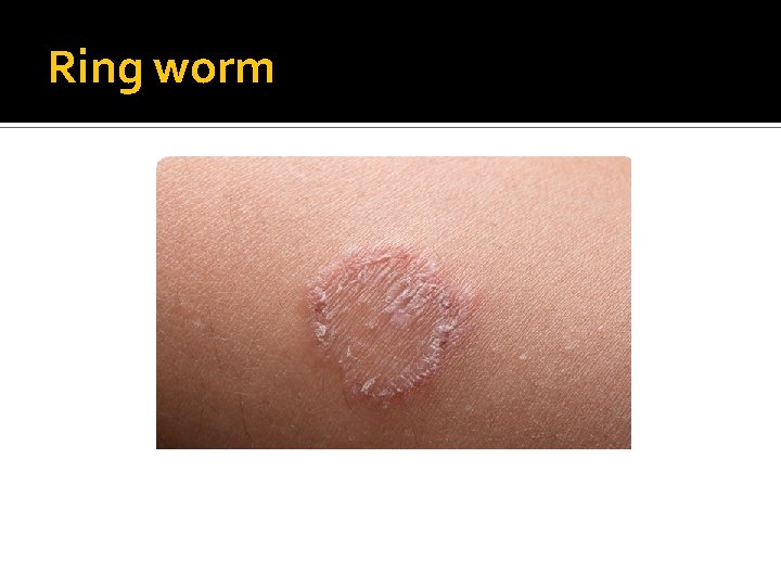 Ring worm 