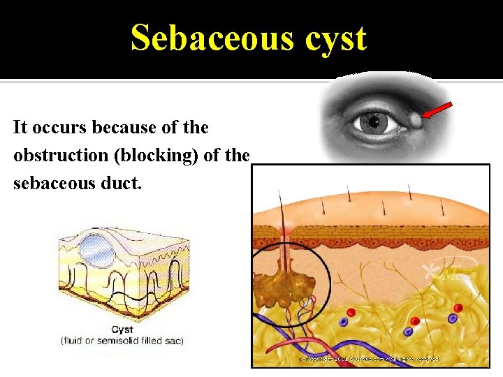 Sebaceous cyst It occurs because of the obstruction (blocking) of the sebaceous duct. 