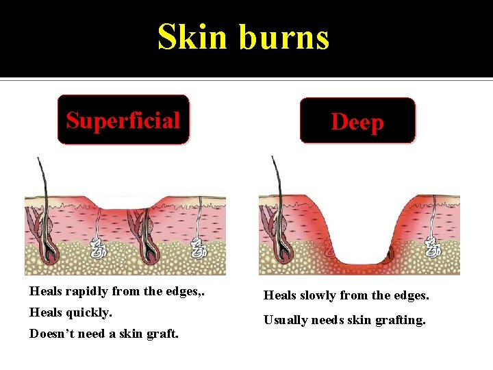 Skin burns Superficial Heals rapidly from the edges, . Heals quickly. Doesn’t need a