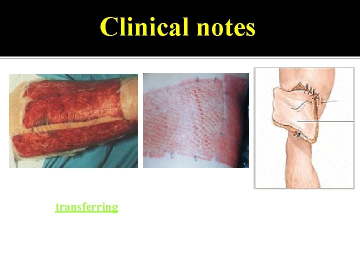Clinical notes Graft is transferring tissue from one site to another. Skin graft is