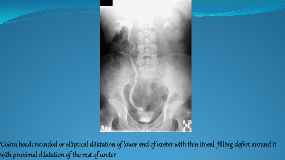 *Cobra head: rounded or elliptical dilatation of lower end of ureter with thin lineal