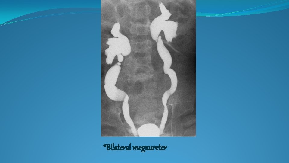 *Bilateral megaureter 