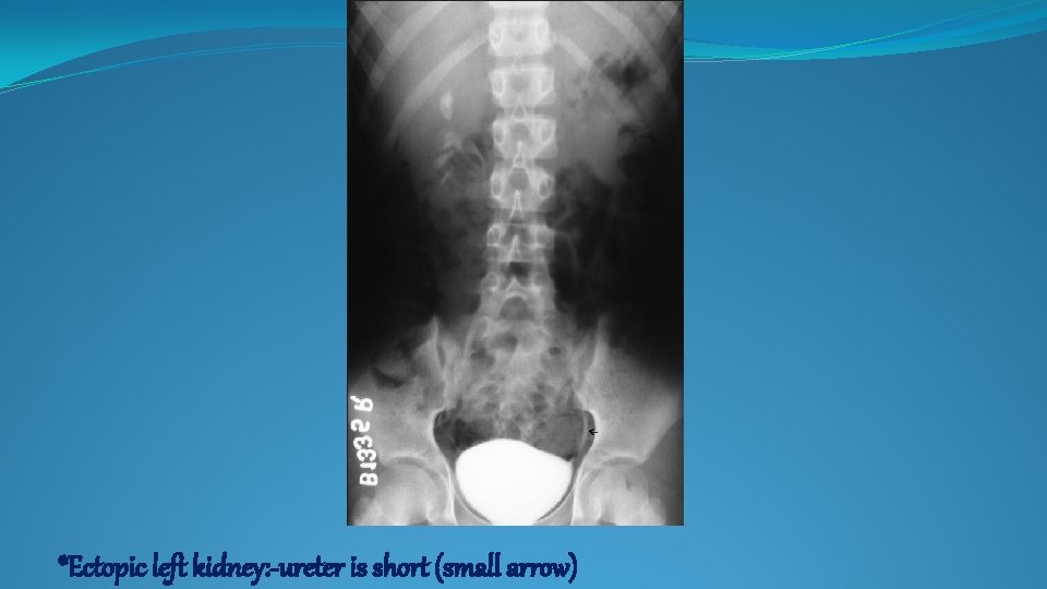 *Ectopic left kidney: -ureter is short (small arrow) 