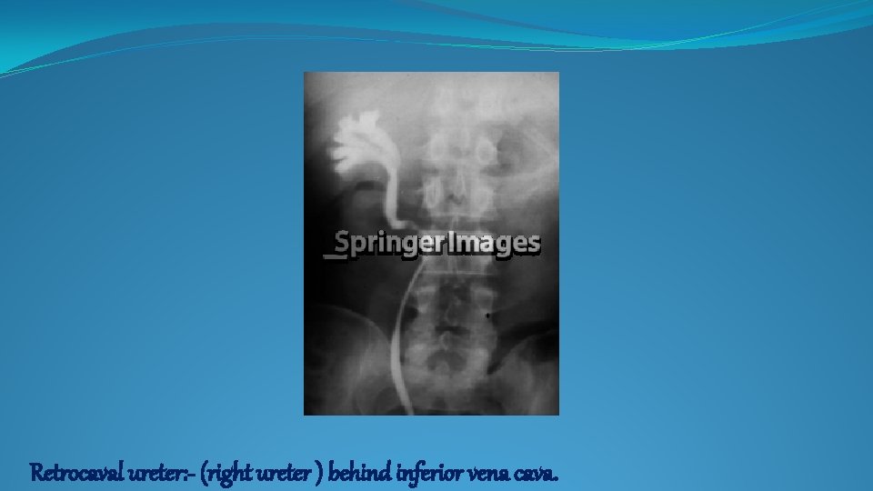 Retrocaval ureter: - (right ureter ) behind inferior vena cava. 