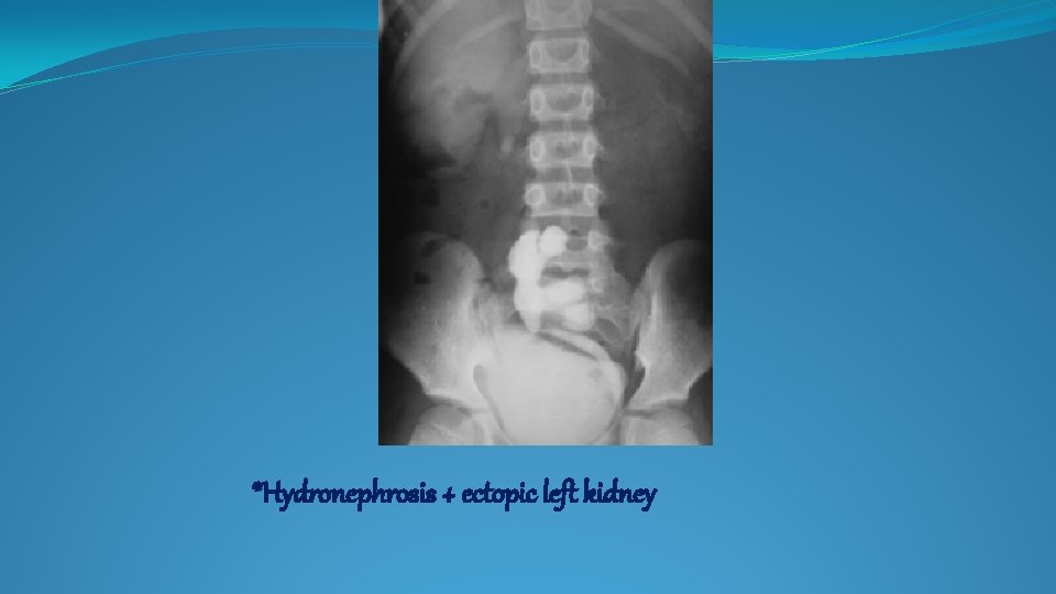 *Hydronephrosis + ectopic left kidney 