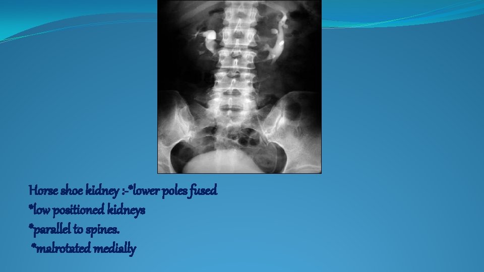 Horse shoe kidney : -*lower poles fused *low positioned kidneys *parallel to spines. *malrotated