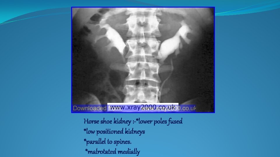 Horse shoe kidney : -*lower poles fused *low positioned kidneys *parallel to spines. *malrotated