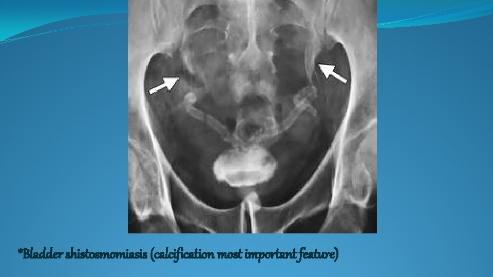 *Bladder shistosmomiasis (calcification most important feature) 