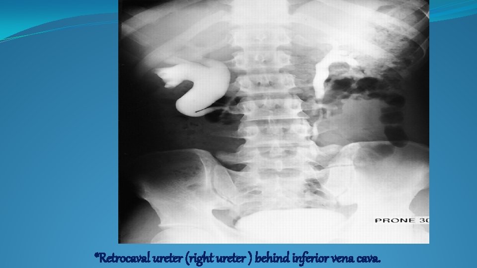 *Retrocaval ureter (right ureter ) behind inferior vena cava. 