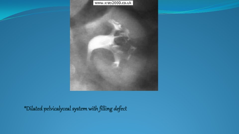 *Dilated pelvicalyceal system with filling defect 