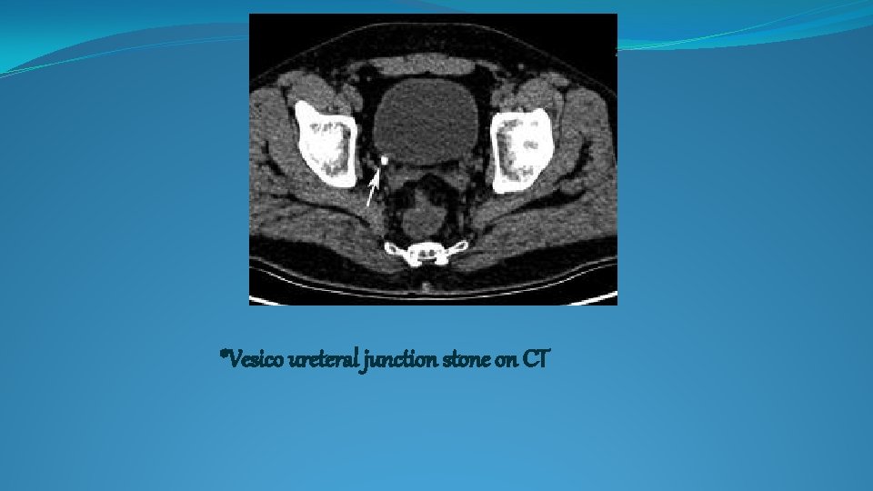 *Vesico ureteral junction stone on CT 