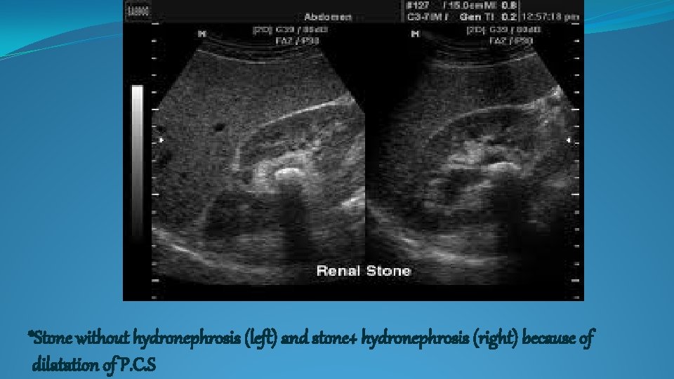 *Stone without hydronephrosis (left) and stone+ hydronephrosis (right) because of dilatation of P. C.