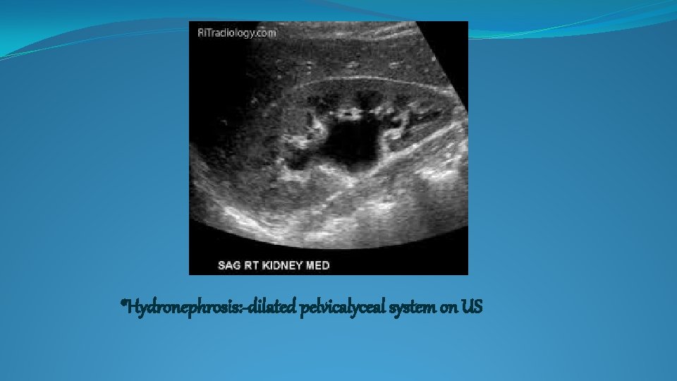 *Hydronephrosis: -dilated pelvicalyceal system on US 