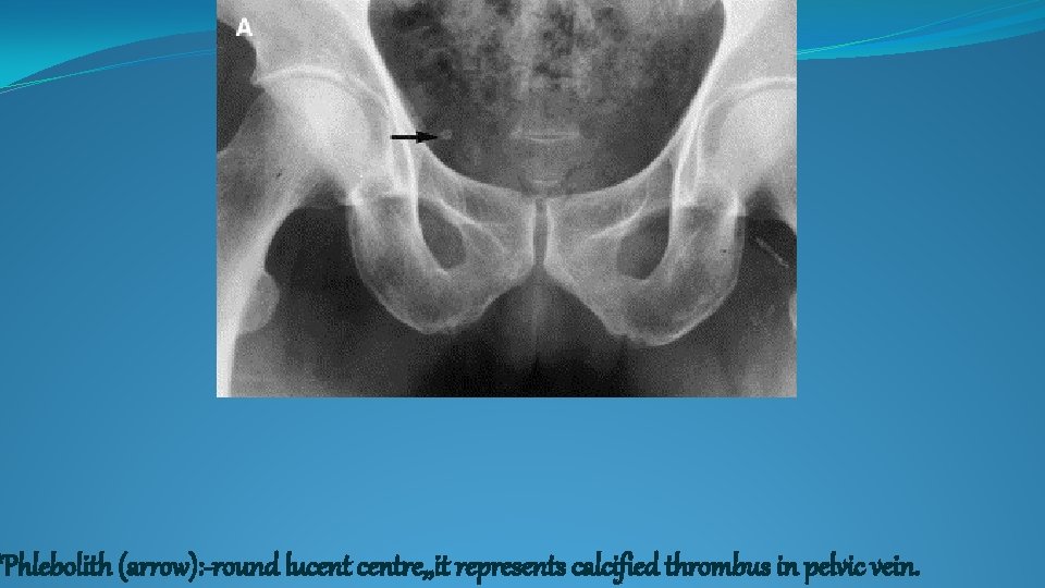 *Phlebolith (arrow): -round lucentre, , it represents calcified thrombus in pelvic vein. 