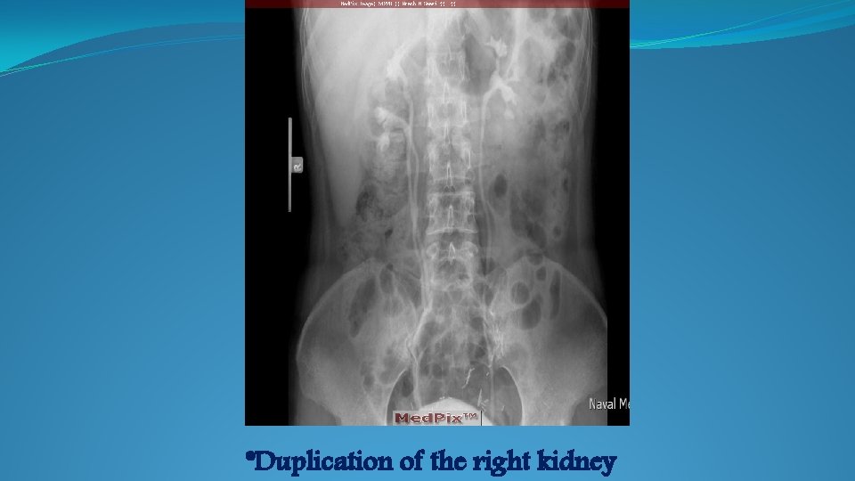 *Duplication of the right kidney 