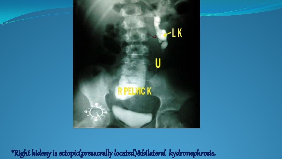 *Right kideny is ectopic(presacrally located)&bilateral hydronephrosis. 