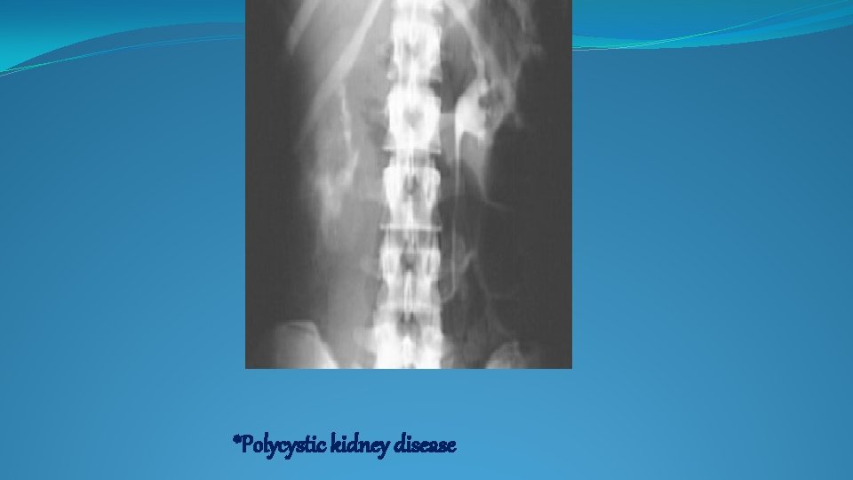 *Polycystic kidney disease 