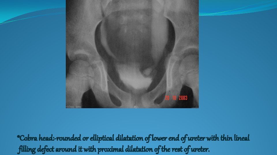 *Cobra head: -rounded or elliptical dilatation of lower end of ureter with thin lineal