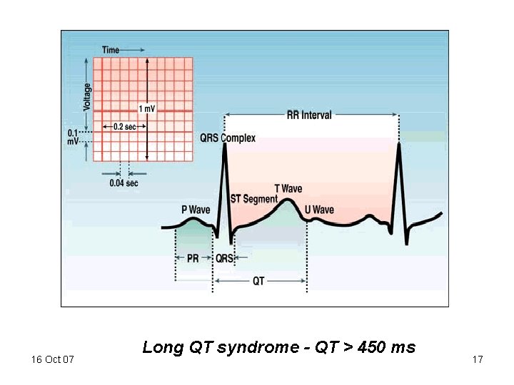 16 Oct 07 Long QT syndrome - QT > 450 ms 17 