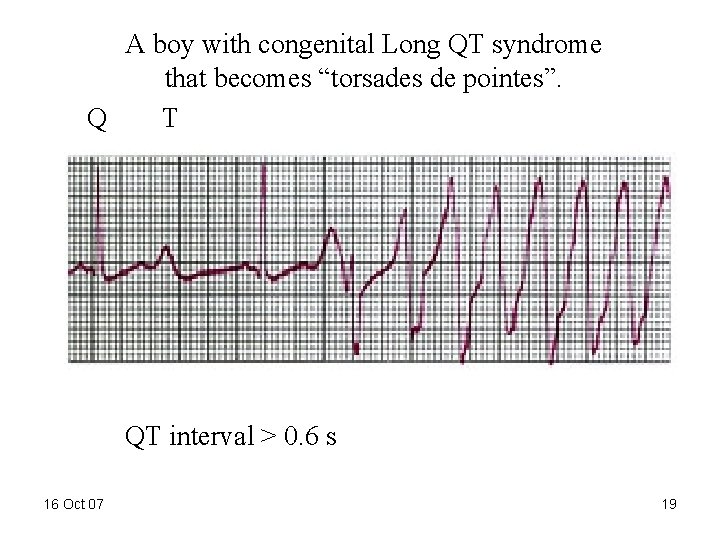 A boy with congenital Long QT syndrome that becomes “torsades de pointes”. Q T