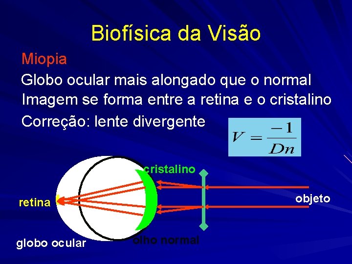 Biofísica da Visão Miopia Globo ocular mais alongado que o normal Imagem se forma