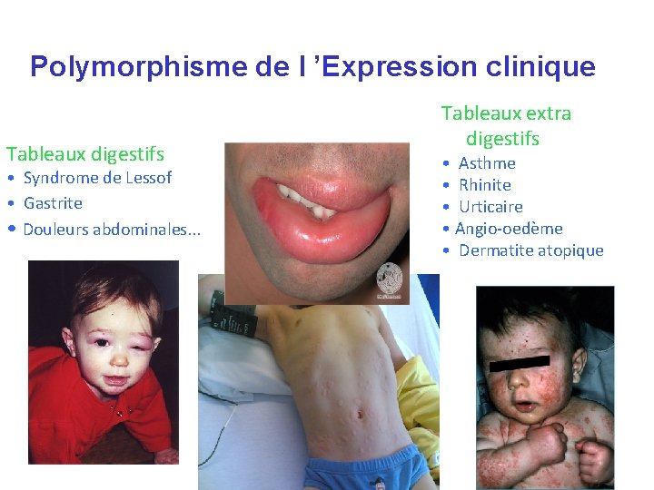 Polymorphisme de l ’Expression clinique Tableaux digestifs • Syndrome de Lessof • Gastrite • Polymorphisme de l ’Expression clinique Tableaux digestifs • Syndrome de Lessof • Gastrite •