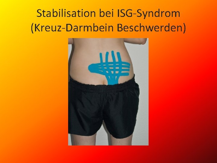 Stabilisation bei ISG-Syndrom (Kreuz-Darmbein Beschwerden) 