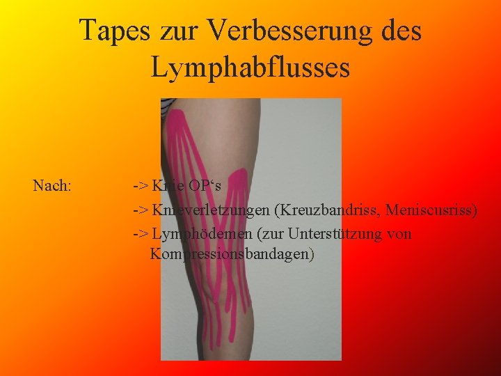 Tapes zur Verbesserung des Lymphabflusses Nach: -> Knie OP‘s -> Knieverletzungen (Kreuzbandriss, Meniscusriss) ->