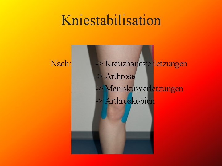 Kniestabilisation Nach: -> Kreuzbandverletzungen -> Arthrose -> Meniskusverletzungen -> Arthroskopien 