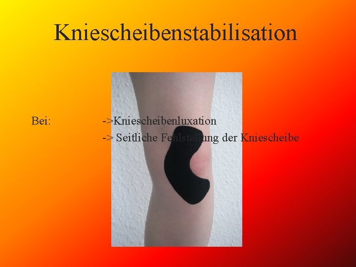 Kniescheibenstabilisation Bei: ->Kniescheibenluxation -> Seitliche Fehlstellung der Kniescheibe 