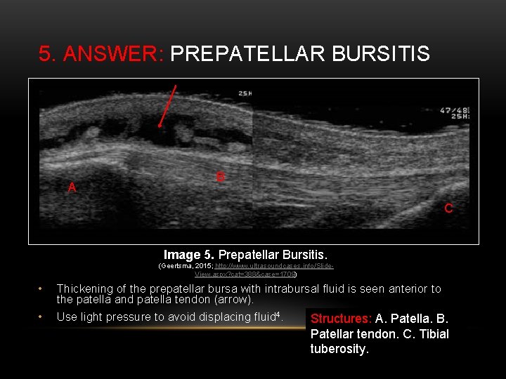 5. ANSWER: PREPATELLAR BURSITIS A B C Image 5. Prepatellar Bursitis. (Geertsma, 2015; http: