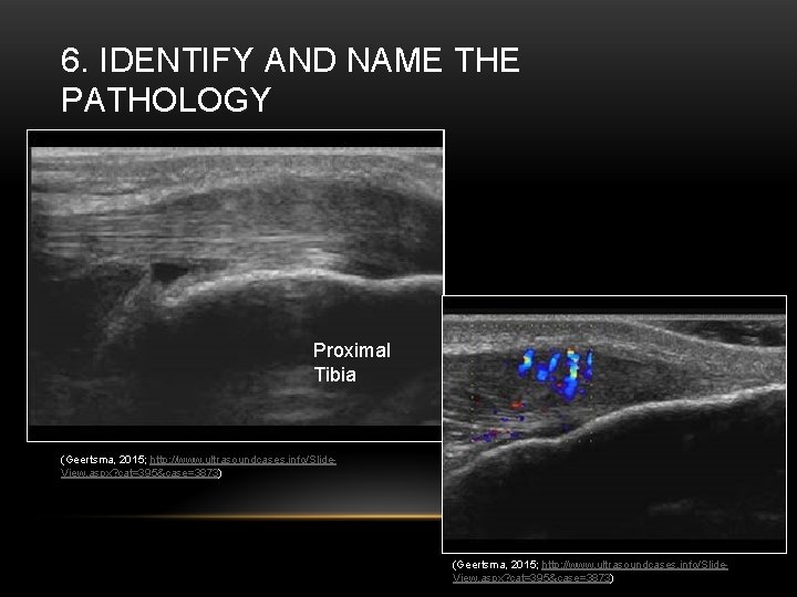 6. IDENTIFY AND NAME THE PATHOLOGY Proximal Tibia (Geertsma, 2015; http: //www. ultrasoundcases. info/Slide.