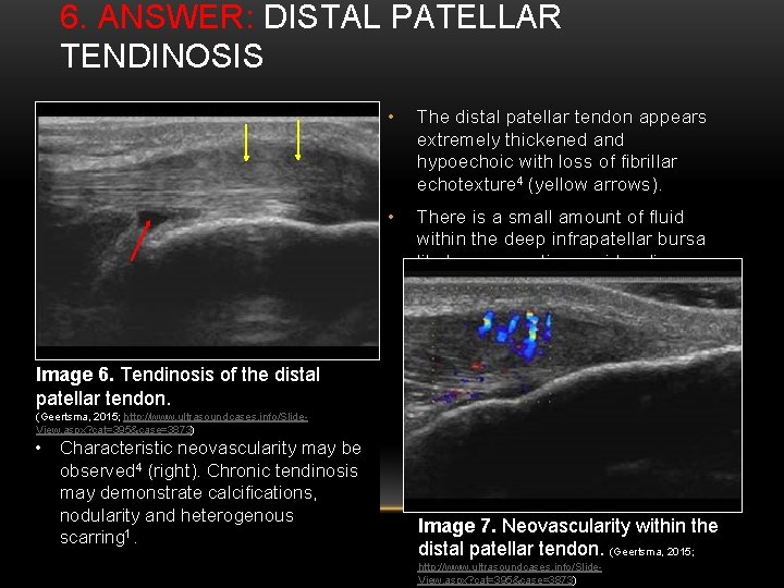 6. ANSWER: DISTAL PATELLAR TENDINOSIS • The distal patellar tendon appears extremely thickened and